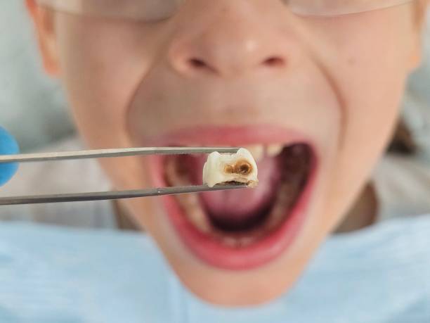 Best Broken or Chipped Tooth Repair in Thorndale, TX