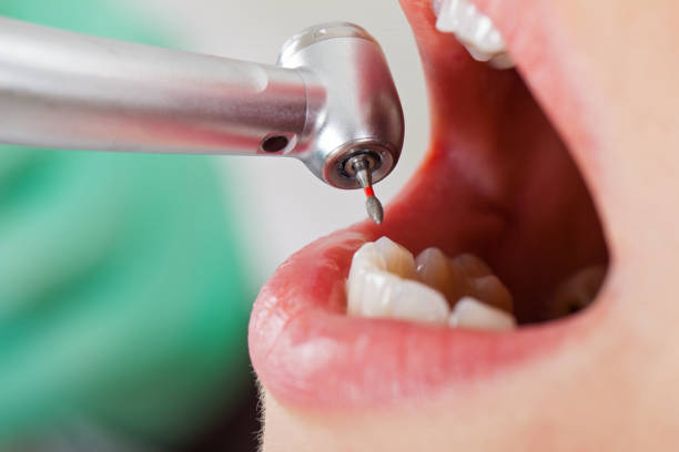 Best Emergency Wisdom Tooth Extraction in Thorndale, TX